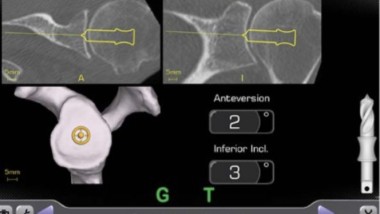 All’Ospedale Sacco la prima protesi di spalla “guidata dal Gps”