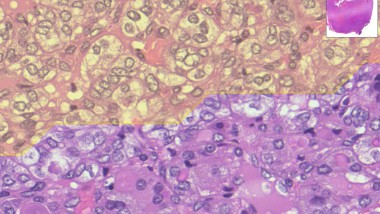 MiThyCA, AI per diagnosi più rapide dei tumori